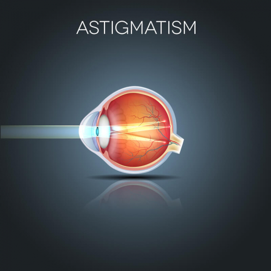 What causes astigmatism and why